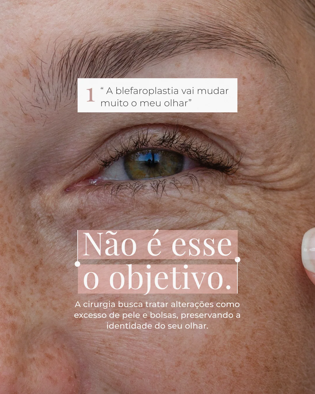Blefaroplastia: dúvidas frequentes — lâmina 2 de 8
