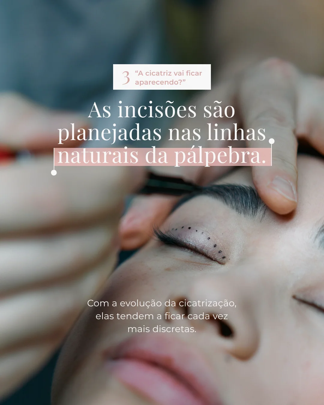 Blefaroplastia: dúvidas frequentes — lâmina 4 de 8